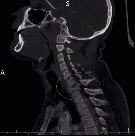 compression fracture without retropulsion